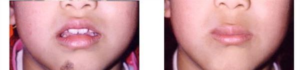 做激光點黑痣有副作用嗎