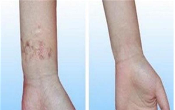 手術(shù)疤痕修復(fù)需要怎么護(hù)理？