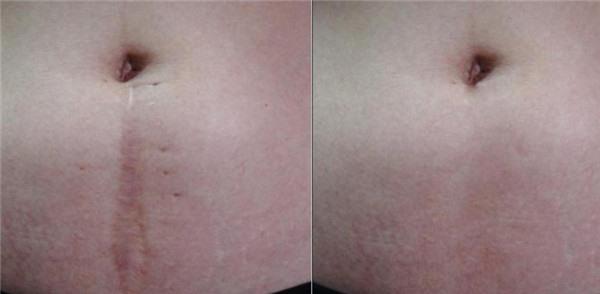 做手術(shù)疤痕修復(fù)價格