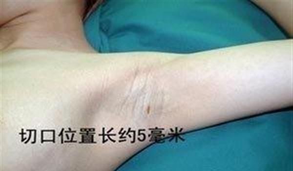 做切除<a href=http://m.f3bb6.cn/listinfo-784-0.html target=_blank class=infotextkey>去狐臭</a>手術多少錢？