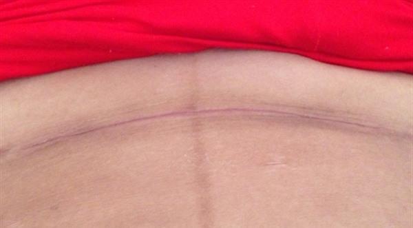 產后如何快速去除疤痕