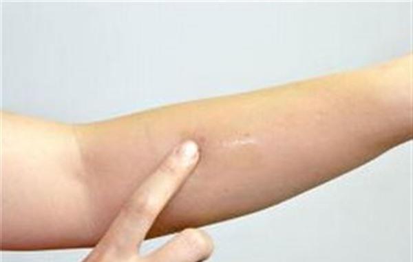 激光去疤的注意事項有哪些