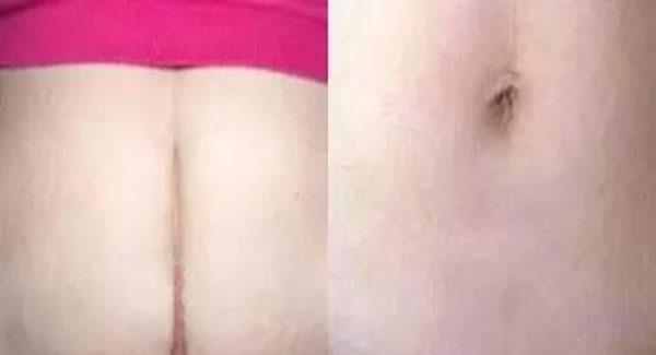 做疤痕增生修復副作用