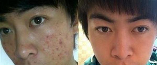 針清祛痘優點有哪些？