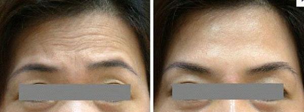 小切口<a href=http://m.f3bb6.cn/listinfo-614-0.html target=_blank class=infotextkey>除皺</a><a href=http://m.f3bb6.cn/listinfo-765-0.html target=_blank class=infotextkey>去抬頭紋</a>手術注意事項是什么？