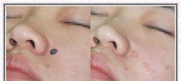 E光點痣適應癥狀是什么？