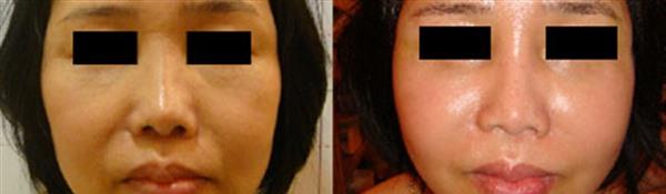 <a href=http://m.f3bb6.cn/listinfo-792-0.html target=_blank class=infotextkey>去法令紋</a>失敗修復手術術后護理？