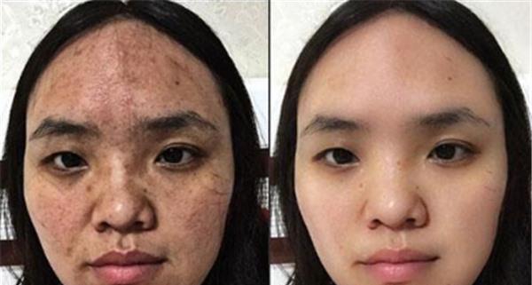 做<a href=http://m.f3bb6.cn/listinfo-730-0.html target=_blank class=infotextkey>黑臉娃娃</a>去痘印價(jià)格大概需要多少