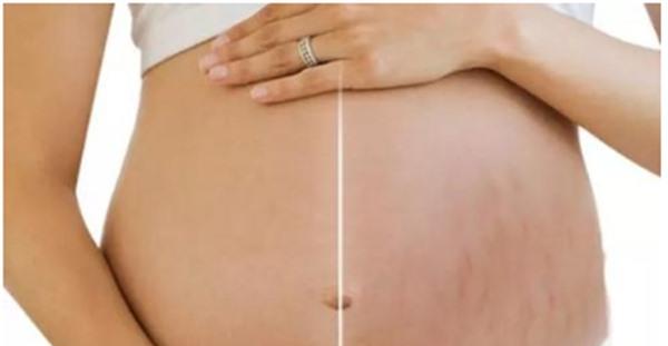 做激光<a href=http://m.f3bb6.cn/listinfo-791-0.html target=_blank class=infotextkey>去妊娠紋</a>不適應人群有哪些