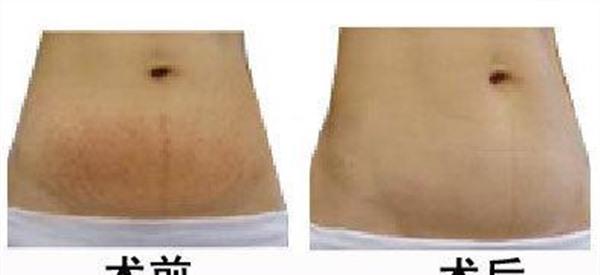 光子<a href=http://m.f3bb6.cn/listinfo-791-0.html target=_blank class=infotextkey>去妊娠紋</a>手術安全嗎?