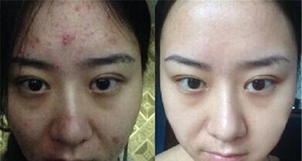 E光祛痘優點有哪些？