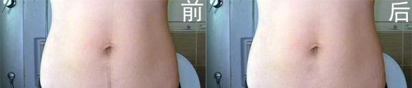 剖腹產疤痕修復要多少錢？