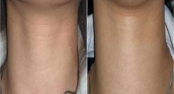 做<a href=http://m.f3bb6.cn/listinfo-731-0.html target=_blank class=infotextkey>玻尿酸</a>除頸紋價格貴嗎