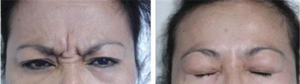 <a href=http://m.f3bb6.cn/listinfo-613-0.html target=_blank class=infotextkey>射頻</a><a href=http://m.f3bb6.cn/listinfo-768-0.html target=_blank class=infotextkey>微針</a><a href=http://m.f3bb6.cn/listinfo-771-0.html target=_blank class=infotextkey>去眉間紋</a>維持時間是多久?