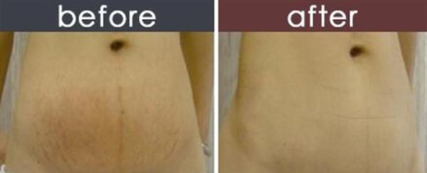 做<a href=http://m.f3bb6.cn/listinfo-613-0.html target=_blank class=infotextkey>射頻</a><a href=http://m.f3bb6.cn/listinfo-791-0.html target=_blank class=infotextkey>去妊娠紋</a>風險有哪些