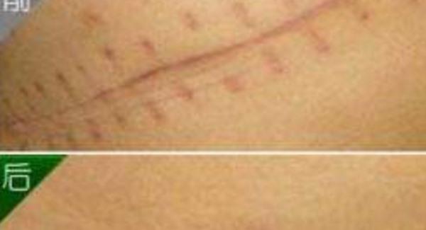 大腿疤痕該怎么辦注意什么