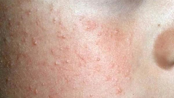 雞皮膚怎么去除?