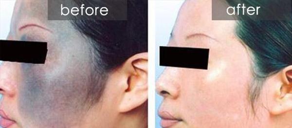 做光子治療太田痣風險有哪些