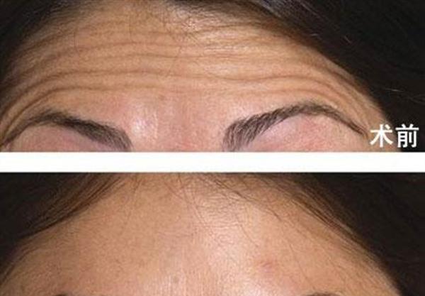 做<a href=http://m.f3bb6.cn/listinfo-734-0.html target=_blank class=infotextkey>愛貝芙</a>去除抬頭紋手術多少錢？