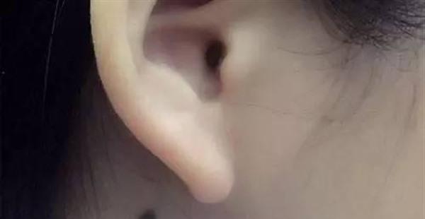 做化學剝脫點痣要花多長時間