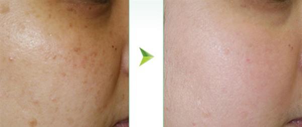 <a href=http://m.f3bb6.cn/listinfo-797-0.html target=_blank class=infotextkey>去痘疤</a>失敗修復手術術后護理?