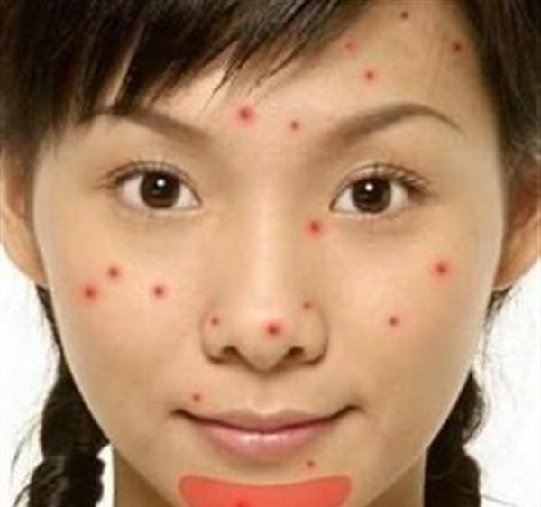 祛痘屬于哪種類型