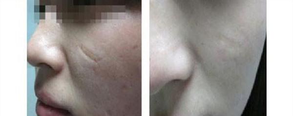 做疤痕增生修復(fù)費用大概需要多少