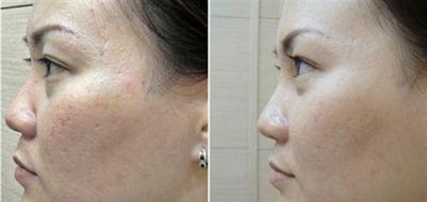 做自體脂肪<a href=http://m.f3bb6.cn/listinfo-797-0.html target=_blank class=infotextkey>去痘疤</a>價格貴不貴