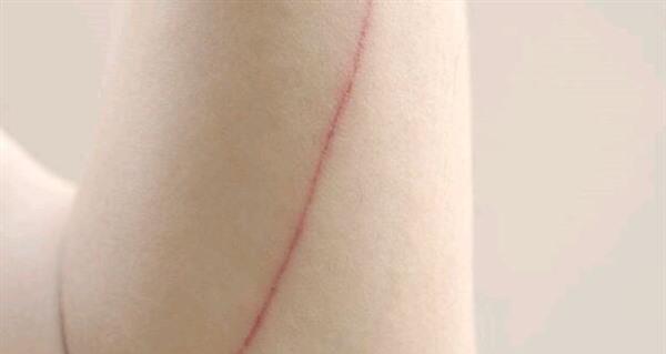 哪兒去疤痕效果好