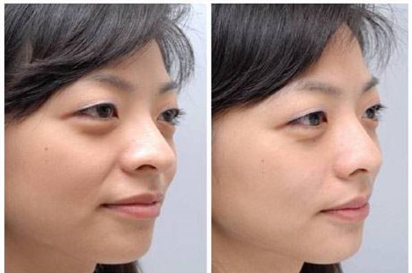 做<a href=http://m.f3bb6.cn/listinfo-792-0.html target=_blank class=infotextkey>去法令紋</a>失敗修復風險有哪些