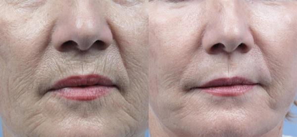 做<a href=http://m.f3bb6.cn/listinfo-768-0.html target=_blank class=infotextkey>微針</a><a href=http://m.f3bb6.cn/listinfo-770-0.html target=_blank class=infotextkey>嫩膚</a>有哪些風險