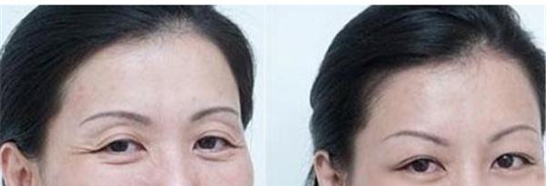 激光<a href=http://m.f3bb6.cn/listinfo-792-0.html target=_blank class=infotextkey>去法令紋</a>適合哪種人？