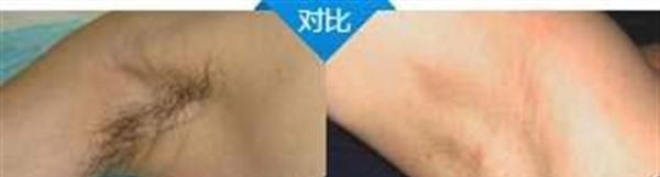 做冷凍<a href=http://m.f3bb6.cn/listinfo-784-0.html target=_blank class=infotextkey>去狐臭</a>多少錢