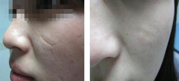 做手術疤痕修復有副作用嗎