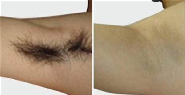 做微波去除腋臭價(jià)格多少錢