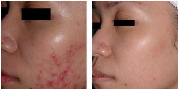 激光去青春痘治療方式是什么？