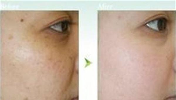 做E光<a href=http://m.f3bb6.cn/listinfo-788-0.html target=_blank class=infotextkey>去黑痣</a>費用大概需要多少