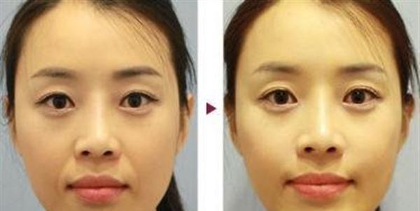 透明質酸<a href=http://m.f3bb6.cn/listinfo-792-0.html target=_blank class=infotextkey>去法令紋</a>效果怎么樣？