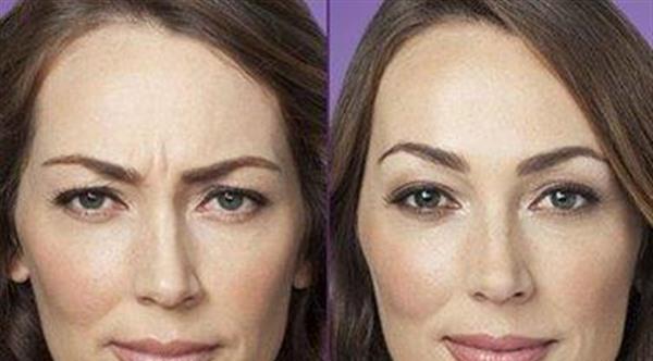 做透明質酸<a href=http://m.f3bb6.cn/listinfo-771-0.html target=_blank class=infotextkey>去眉間紋</a>效果怎么樣