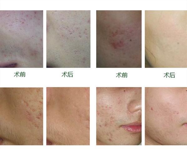 做自體脂肪<a href=http://m.f3bb6.cn/listinfo-797-0.html target=_blank class=infotextkey>去痘疤</a>效果好不好