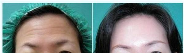 <a href=http://m.f3bb6.cn/listinfo-613-0.html target=_blank class=infotextkey>射頻</a><a href=http://m.f3bb6.cn/listinfo-768-0.html target=_blank class=infotextkey>微針</a><a href=http://m.f3bb6.cn/listinfo-771-0.html target=_blank class=infotextkey>去眉間紋</a>手術缺點有哪些？