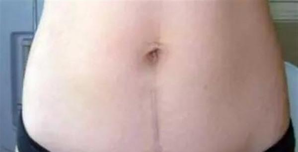 剖腹產疤痕修復多少錢一次