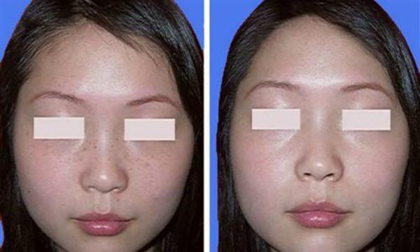 <a href=http://m.f3bb6.cn/listinfo-774-0.html target=_blank class=infotextkey>去雀斑</a>手術安全嗎？