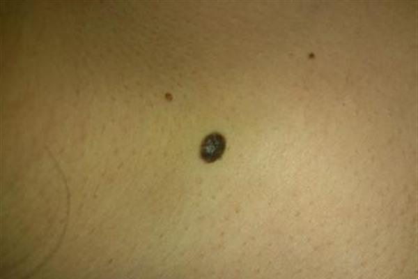 做<a href=http://m.f3bb6.cn/listinfo-788-0.html target=_blank class=infotextkey>去黑痣</a>手術多少錢？