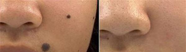 化學剝脫點痣手術的方法是什么？