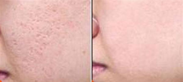 切除縫合治療痘疤適應癥狀是什么？