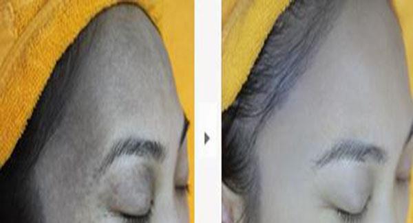 做<a href=http://m.f3bb6.cn/listinfo-799-0.html target=_blank class=infotextkey>去太田痣</a>副作用