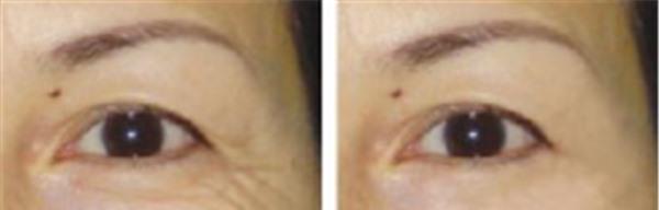 做<a href=http://m.f3bb6.cn/listinfo-782-0.html target=_blank class=infotextkey>去眼角細紋</a>失敗修復不適應人群有哪些