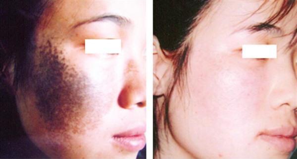 做皮膚磨削治太田痣費用要多少