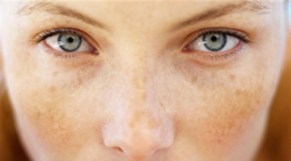 臉上黑色素沉淀怎么去除